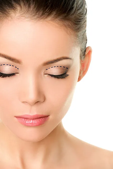 Eyelid Surgery