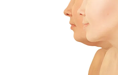 Facial Liposuction