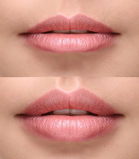 Botox Cosmetic	